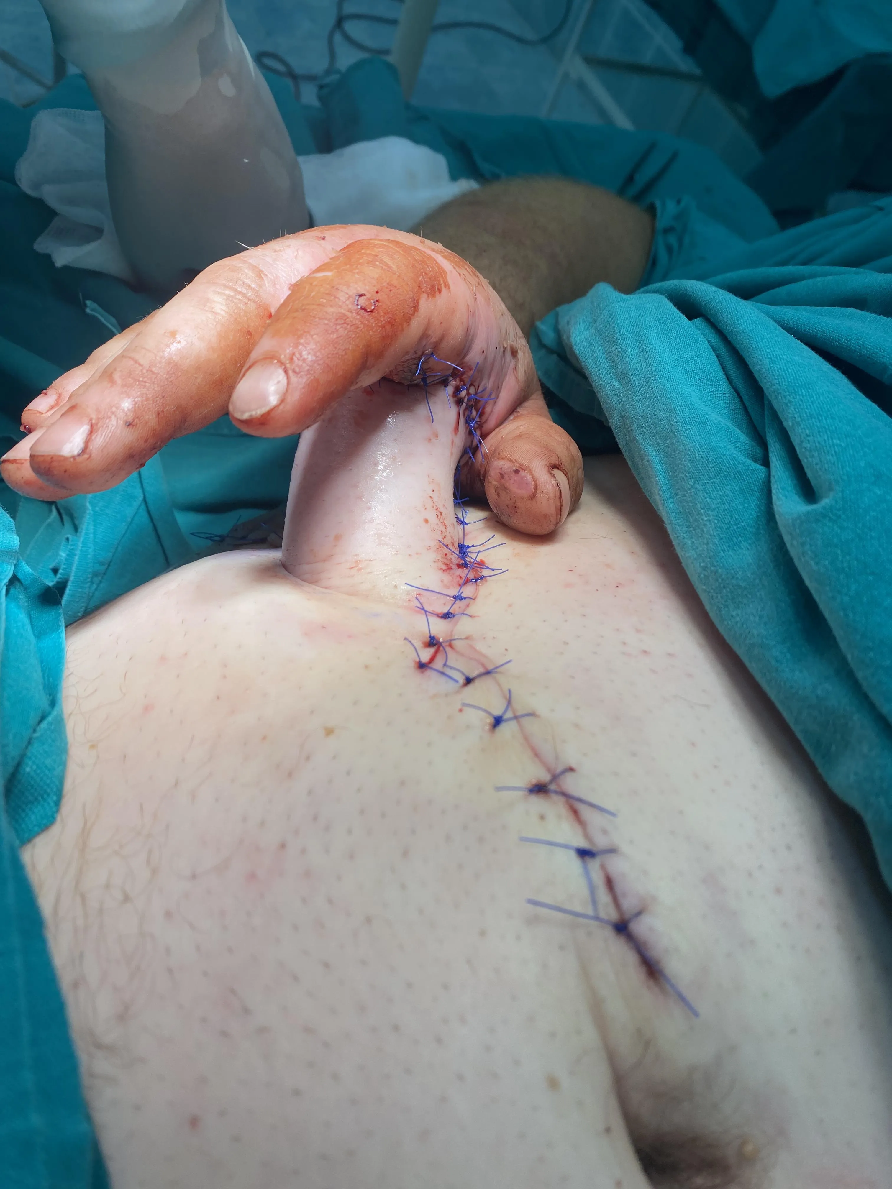 Восстановление кожных покровов